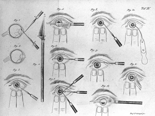 The image shows a black and white drawing of a person's eye with various surgical instruments, such...
